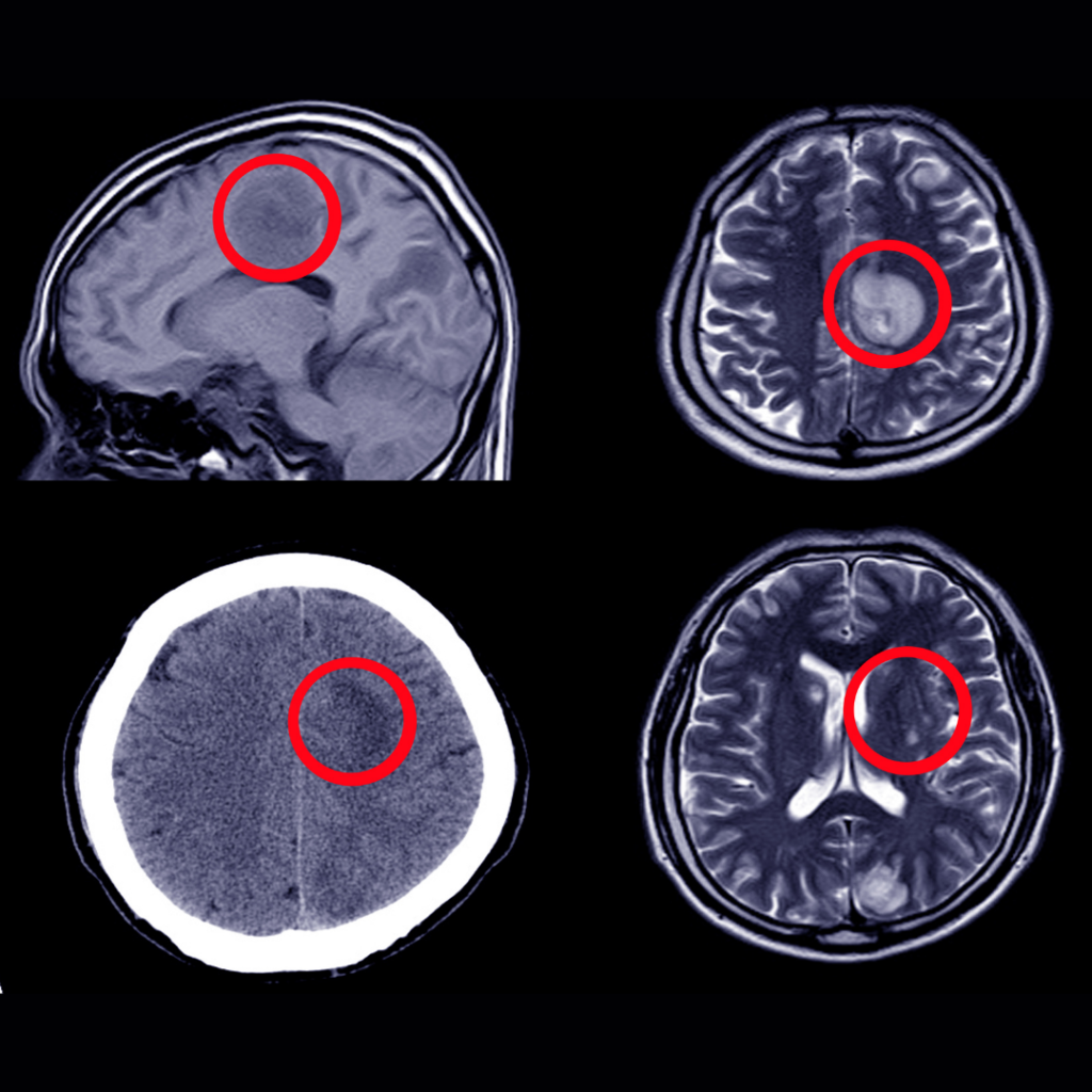 Hidrosefali Nedir? Hidrosefali Nedir?